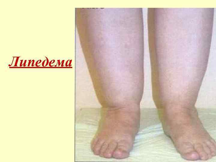 Липедема 
