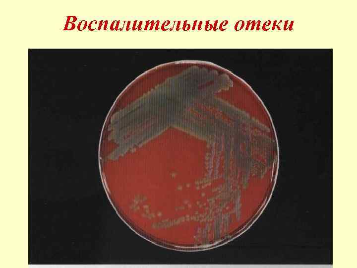 Воспалительные отеки 