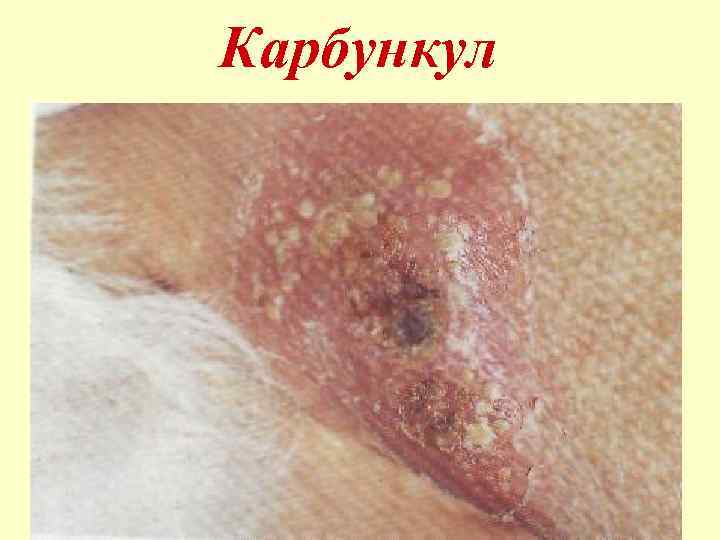 Карбункул 