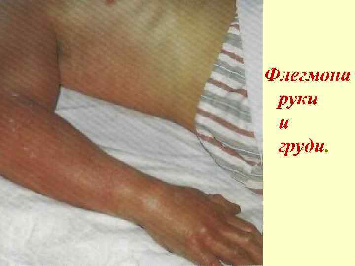  Флегмона руки и груди. 