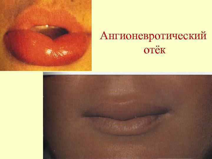 Ангионевротический отёк 