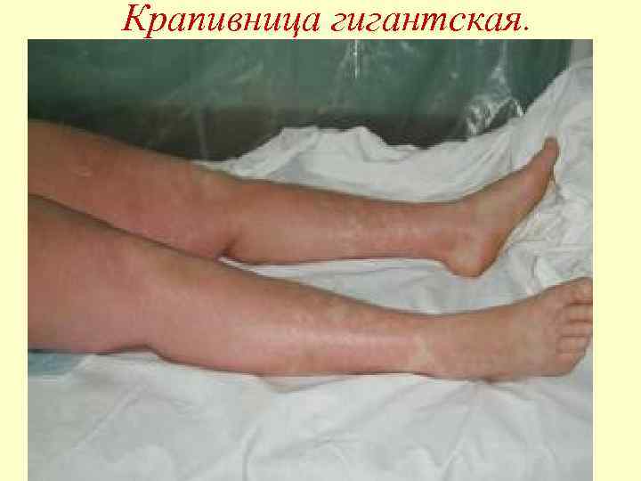 Крапивница гигантская. 