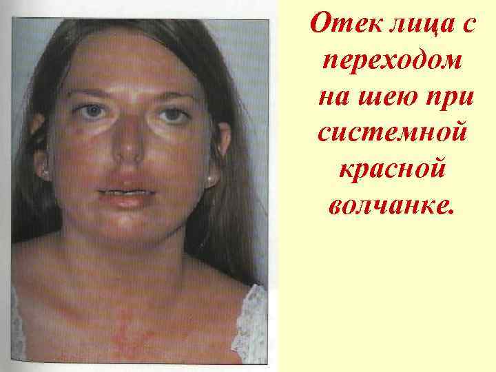 Отек лица с переходом на шею при системной красной волчанке. 