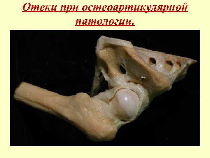 Отеки при остеоартикулярной патологии. 