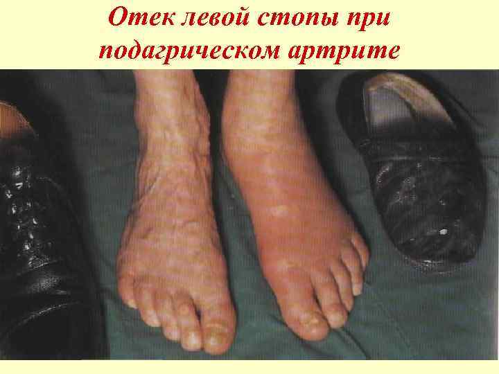 Отек левой стопы при подагрическом артрите 