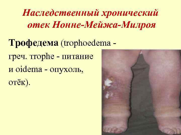 Наследственный хронический отек Нонне-Мейжа-Милроя Трофедема (trophoedema греч. тrophe - питание и oidema - опухоль,