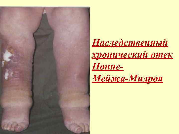 Наследственный хронический отек Нонне. Мейжа-Милроя 