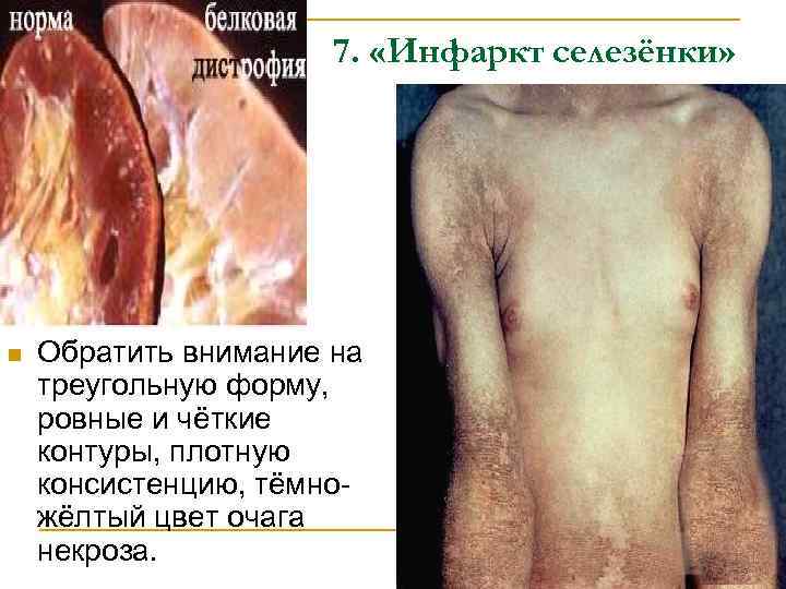 7. «Инфаркт селезёнки» n Обратить внимание на треугольную форму, ровные и чёткие контуры, плотную