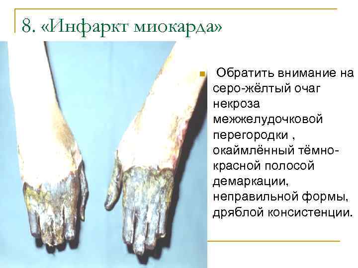 8. «Инфаркт миокарда» n Обратить внимание на серо-жёлтый очаг некроза межжелудочковой перегородки , окаймлённый