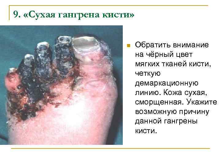 9. «Сухая гангрена кисти» n Обратить внимание на чёрный цвет мягких тканей кисти, четкую
