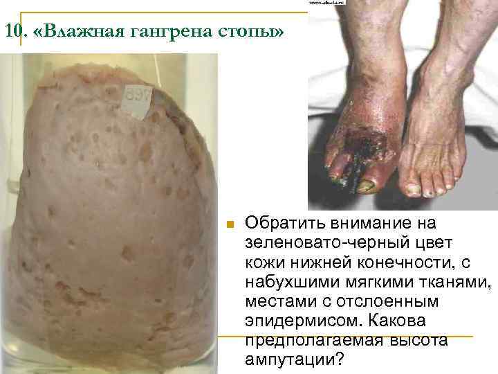 10. «Влажная гангрена стопы» n Обратить внимание на зеленовато-черный цвет кожи нижней конечности, с