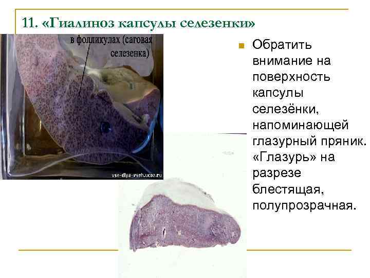 11. «Гиалиноз капсулы селезенки» n Обратить внимание на поверхность капсулы селезёнки, напоминающей глазурный пряник.