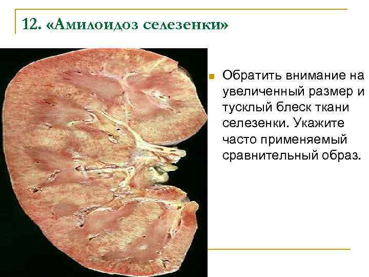 12. «Амилоидоз селезенки» n Обратить внимание на увеличенный размер и тусклый блеск ткани селезенки.