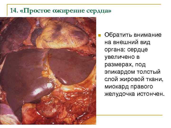 14. «Простое ожирение сердца» n Обратить внимание на внешний вид органа: сердце увеличено в