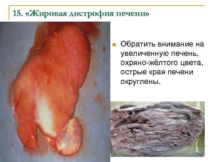 15. «Жировая дистрофия печени» n Обратить внимание на увеличенную печень, охряно-жёлтого цвета, острые края