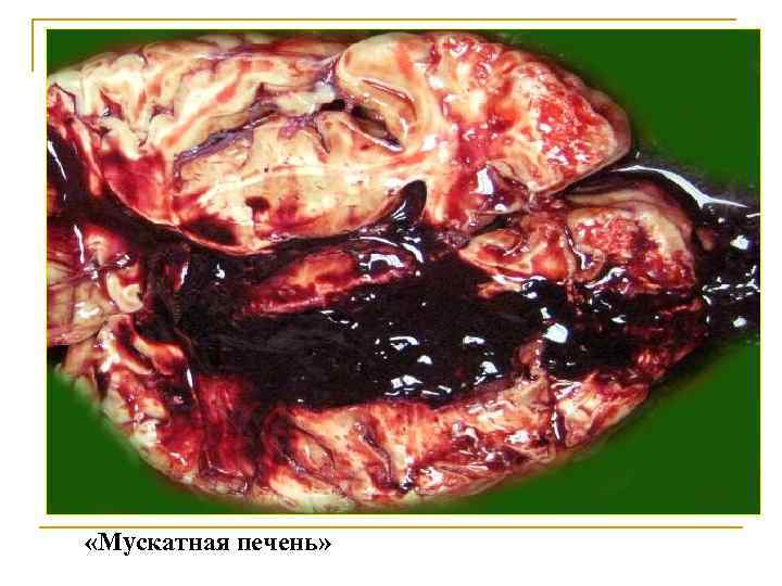  «Мускатная печень» 