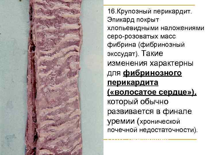 16. Крупозный перикардит. Эпикард покрыт хлопьевидными наложениями серо-розоватых масс фибрина (фибринозный экссудат). Такие изменения