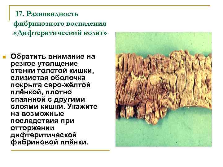 17. Разновидность фибринозного воспаления «Дифтеритический колит» n Обратить внимание на резкое утолщение стенки толстой