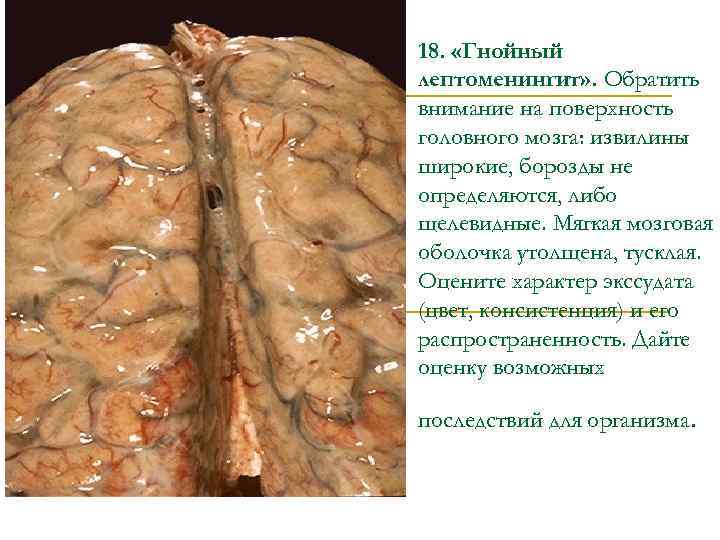 18. «Гнойный лептоменингит» . Обратить внимание на поверхность головного мозга: извилины широкие, борозды не