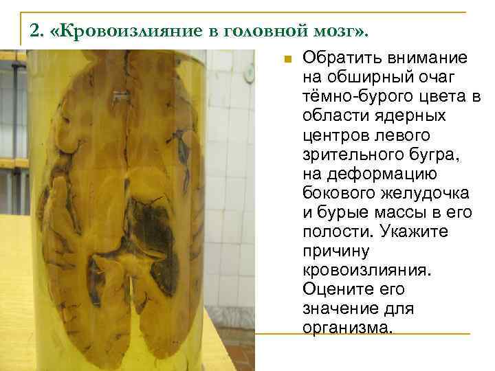 2. «Кровоизлияние в головной мозг» . n Обратить внимание на обширный очаг тёмно-бурого цвета