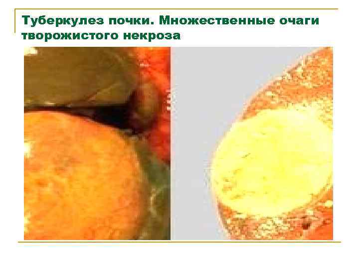 Туберкулез почки. Множественные очаги творожистого некроза 