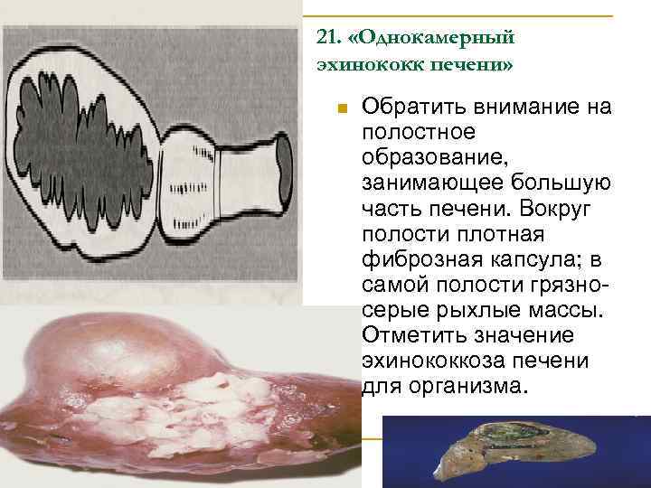 21. «Однокамерный эхинококк печени» n Обратить внимание на полостное образование, занимающее большую часть печени.