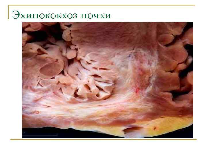 Эхинококкоз почки 