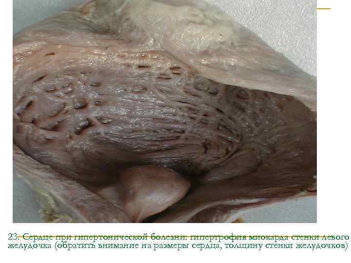 23. Сердце при гипертонической болезни: гипертрофия миокарда стенки левого желудочка (обратить внимание на размеры