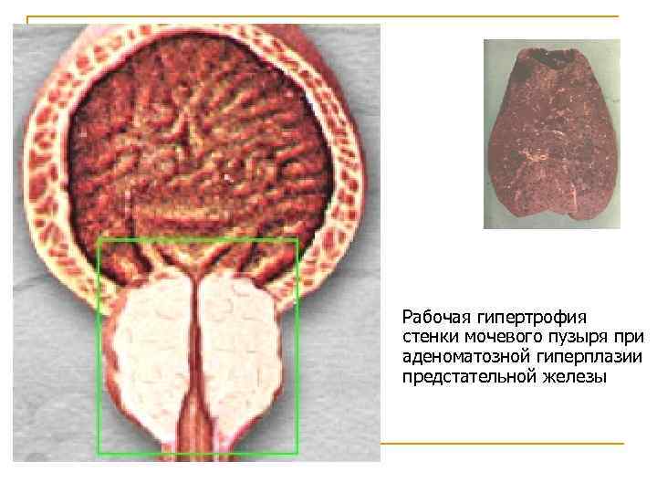 Рабочая гипертрофия стенки мочевого пузыря при аденоматозной гиперплазии предстательной железы 