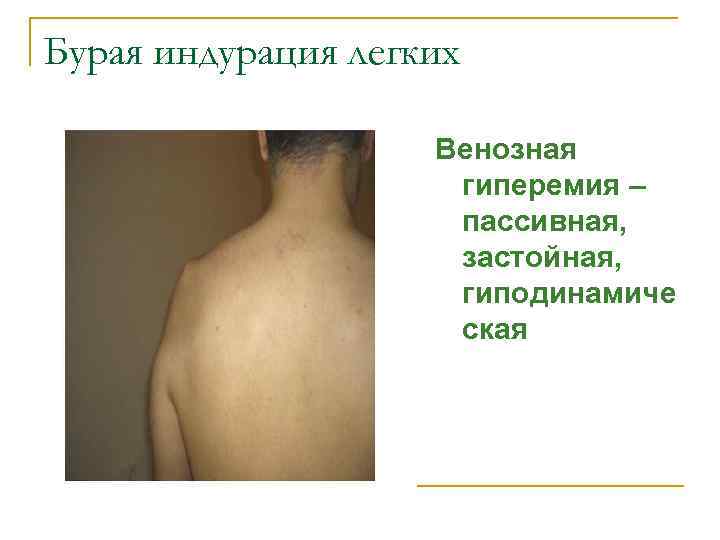 Бурая индурация легких Венозная гиперемия – пассивная, застойная, гиподинамиче ская 