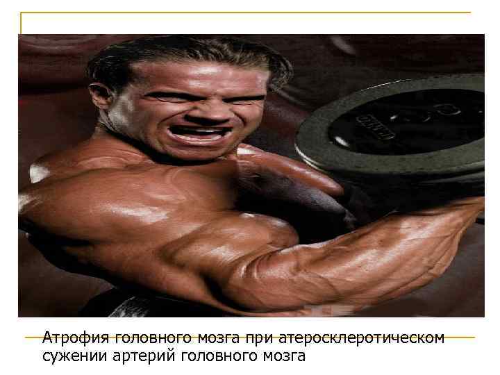 Атрофия головного мозга при атеросклеротическом сужении артерий головного мозга 
