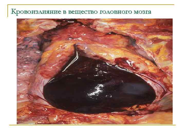 Кровоизлияние в вещество головного мозга 