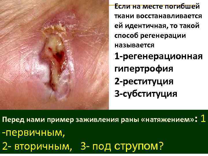 Если на месте погибшей ткани восстанавливается ей идентичная, то такой способ регенерации называется 1
