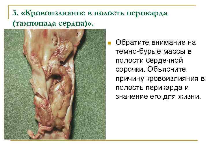 3. «Кровоизлияние в полость перикарда (тампонада сердца)» . n Обратите внимание на темно-бурые массы