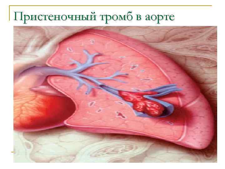 Пристеночный тромб в аорте 