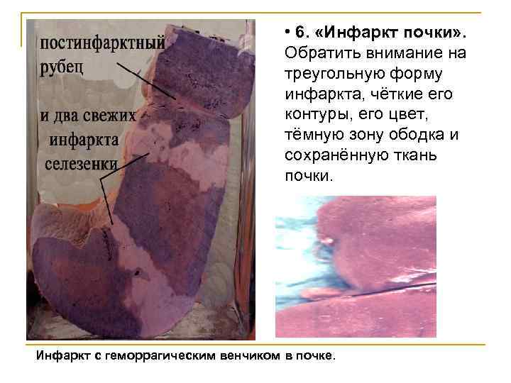  • 6. «Инфаркт почки» . Обратить внимание на треугольную форму инфаркта, чёткие его