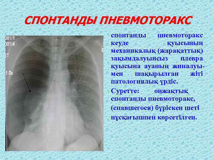 СПОНТАНДЫ ПНЕВМОТОРАКС спонтанды пневмоторакс кеуде қуысының механикалық (жарақаттық) зақымдалуынсыз плевра қуысына ауаның жиналуымен шақырылған