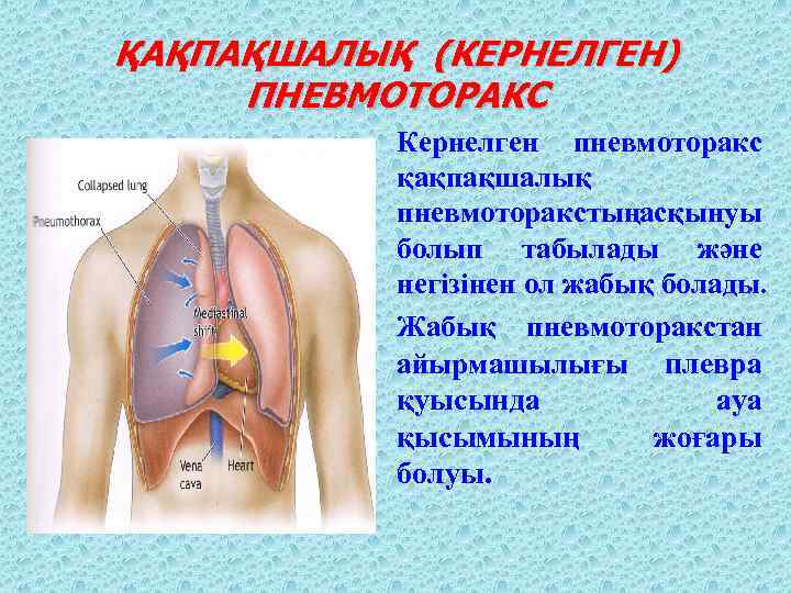 ҚАҚПАҚШАЛЫҚ (КЕРНЕЛГЕН) ПНЕВМОТОРАКС Кернелген пневмоторакс қақпақшалық пневмоторакстыңасқынуы болып табылады және негізінен ол жабық болады.