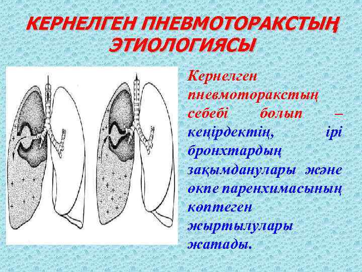 КЕРНЕЛГЕН ПНЕВМОТОРАКСТЫҢ ЭТИОЛОГИЯСЫ Кернелген пневмоторакстың себебі болып – кеңірдектің, ірі бронхтардың зақымданулары және өкпе