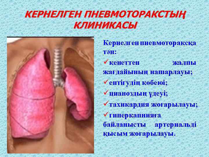 КЕРНЕЛГЕН ПНЕВМОТОРАКСТЫҢ КЛИНИКАСЫ Кернелген пневмотораксқа тән: üкенеттен жалпы жағдайының нашарлауы; üентігудің көбеюі; üцианоздың үдеуі;