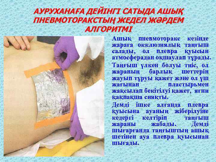 АУРУХАНАҒА ДЕЙІНГІ САТЫДА АШЫҚ ПНЕВМОТОРАКСТЫҢ ЖЕДЕЛ ЖӘРДЕМ АЛГОРИТМІ Ашық пневмоторакс кезінде жараға окклюзиялық таңғыш