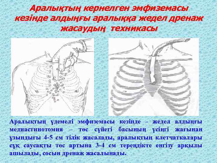 Аралықтың кернелген эмфиземасы кезінде алдыңғы аралыққа жедел дренаж жасаудың техникасы Аралықтың үдемелі эмфиземасы кезінде