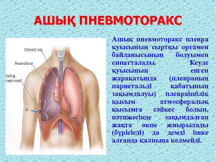 АШЫҚ ПНЕВМОТОРАКС Ашық пневмоторакс плевра қуысының сыртқы ортамен байланысының болуымен сипатталады. Кеуде қуысының енген