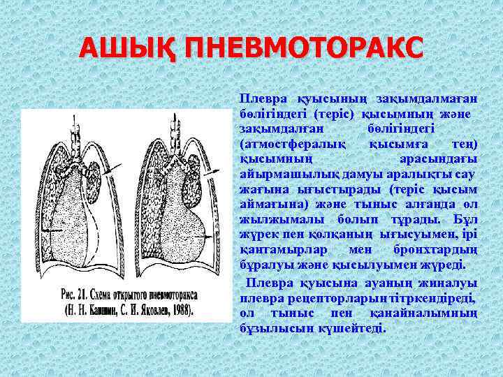 АШЫҚ ПНЕВМОТОРАКС Плевра қуысының зақымдалмаған бөлігіндегі (теріс) қысымның және зақымдалған бөлігіндегі (атмостфералық қысымға тең)