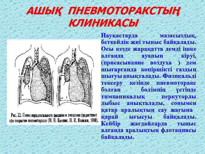 АШЫҚ ПНЕВМОТОРАКСТЫҢ КЛИНИКАСЫ Науқастарда мазасыздық, беткейлік жиі тыныс байқалады. Осы кезде жарақатта демді ішке