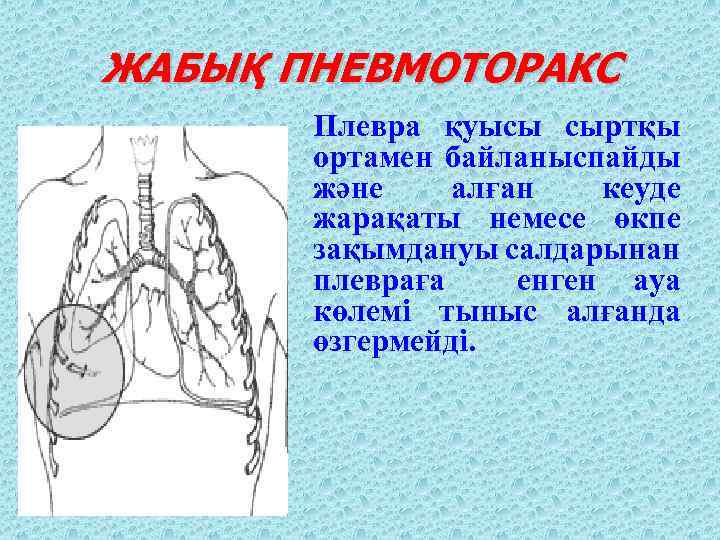 ЖАБЫҚ ПНЕВМОТОРАКС Плевра қуысы сыртқы ортамен байланыспайды және алған кеуде жарақаты немесе өкпе зақымдануы