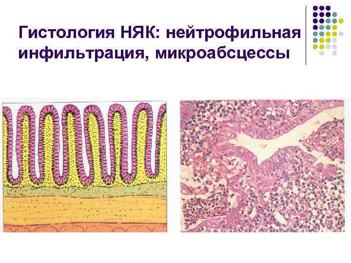 Гистология НЯК: нейтрофильная инфильтрация, микроабсцессы 