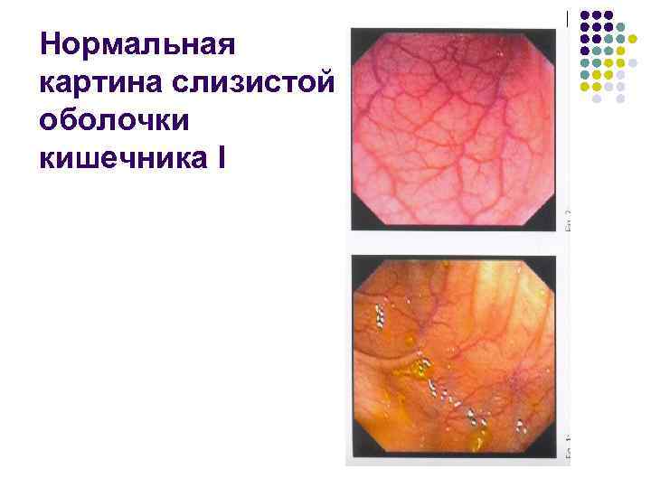 Нормальная картина слизистой оболочки кишечника I 