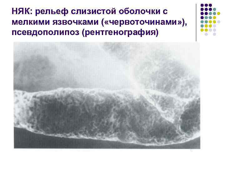 НЯК: рельеф слизистой оболочки с мелкими язвочками ( «червоточинами» ), псевдополипоз (рентгенография) 
