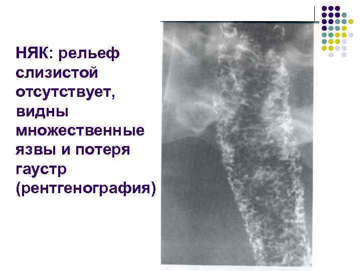 НЯК: рельеф слизистой отсутствует, видны множественные язвы и потеря гаустр (рентгенография) 